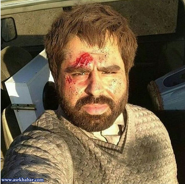 توضیح امیر نوری درباره عکس با صورت مجروحش /عکس