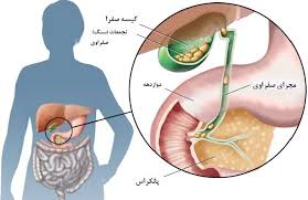 فاکتورهای خطرزا در بروز سنگ کیسه صفرا فاکتورهای خطرزا در بروز سنگ کیسه صفرا