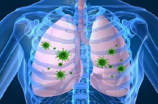 چرایی شدت درگیری ریه در افراد مختلف با کرونا مشخص نیست چرایی شدت درگیری ریه در افراد مختلف با کرونا مشخص نیست