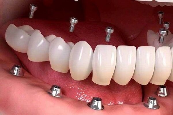 بهترین جایگزین ایمپلنت چیست؟