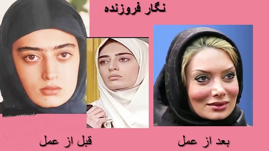عکس | تفاوت چهره نگار فروزنده قبل و بعد از عمل جراحی