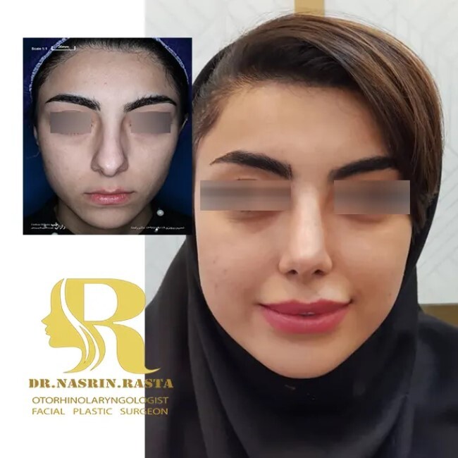 مشاوره جراحی بینی مشاوره جراحی بینی