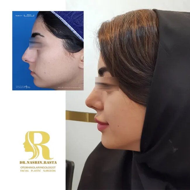 مشاوره جراحی بینی مشاوره جراحی بینی